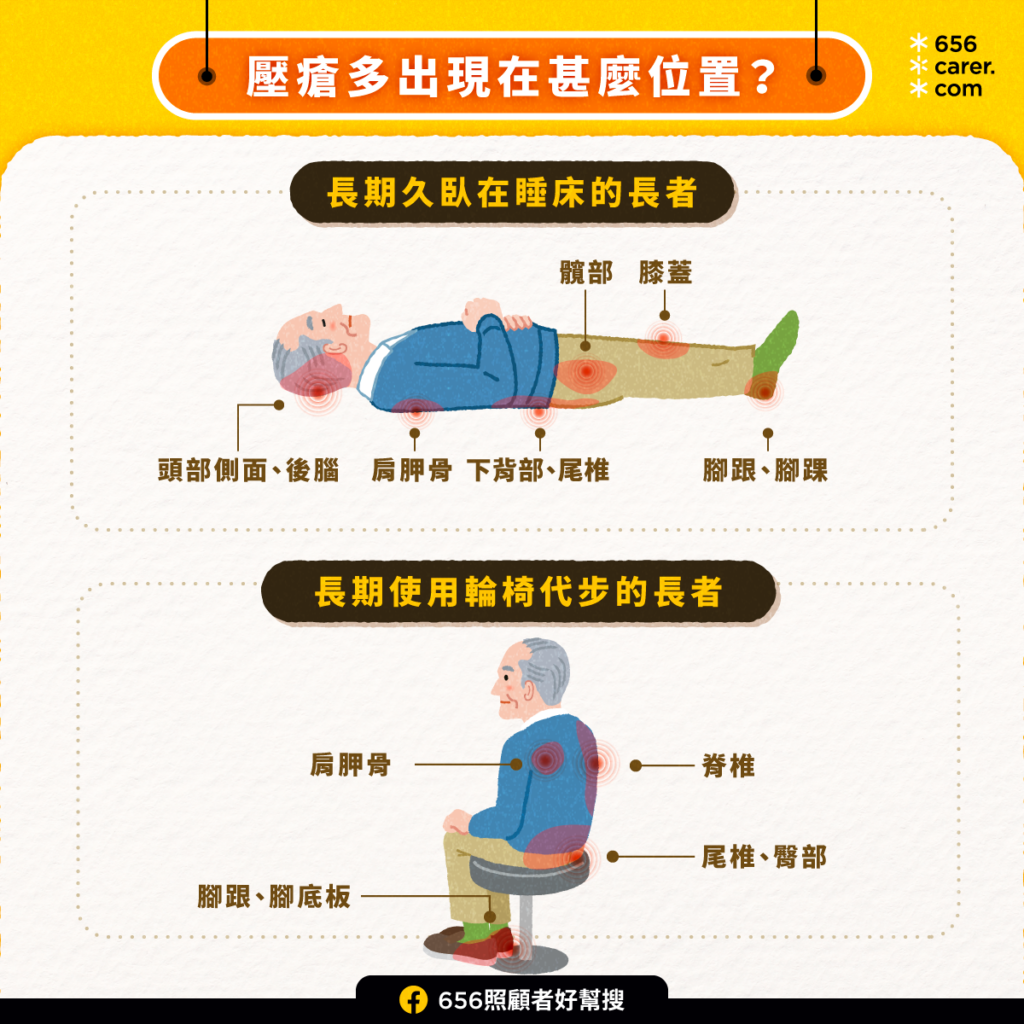 褥瘡護理全攻略|壓瘡分級與治療方法一覽|護老者必讀